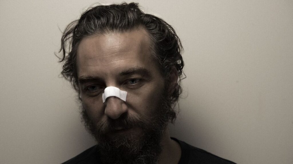 Dance videos: Ulrich Forman with a plaster on his nose